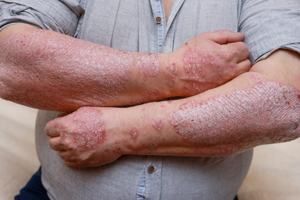 psoriase