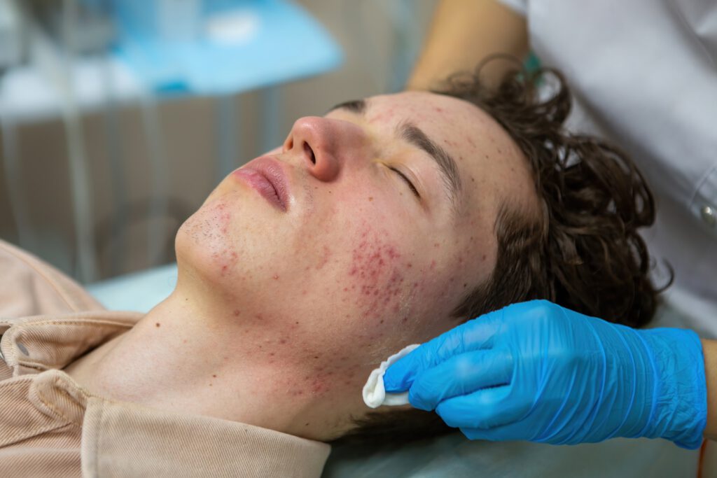 Acne: Causas, Tipos e Tratamentos Eficazes 2 tratamento acne