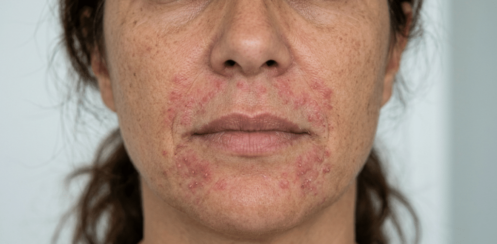 dermatite perioral à volta da boca
